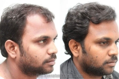 hair-replacement-image-right-168457