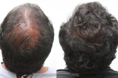 hair-replacement-photo-crown-168457