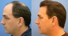 hair-transplantation-250x250