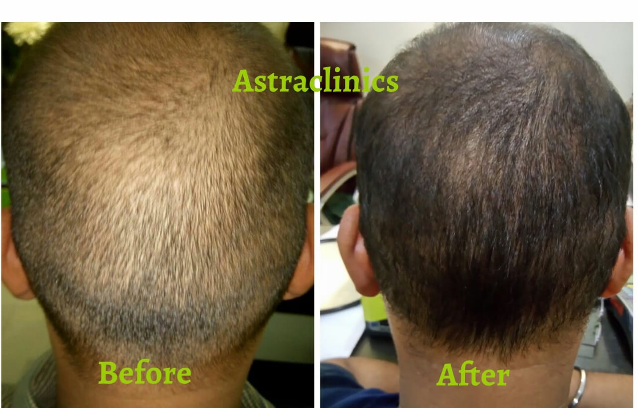 Best Increase in Hairs Volume Treatment In Pune