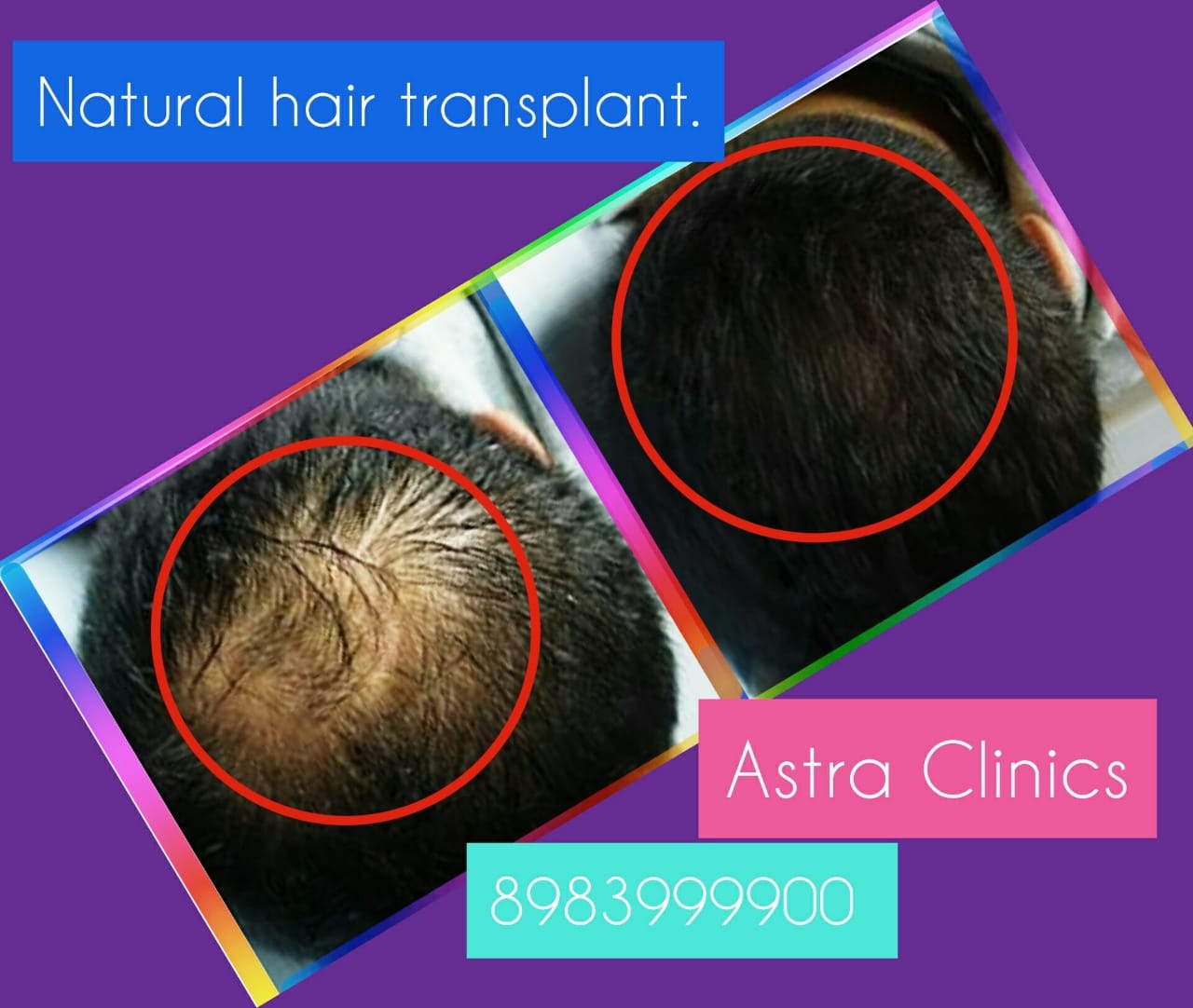Best Crown Hair Transplant Treatment In Pune