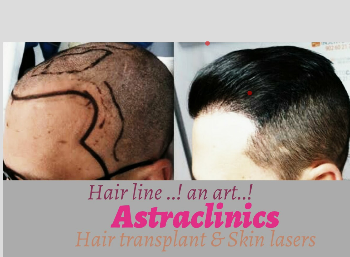 Best Increase in Hairs Volume Treatment In Pune