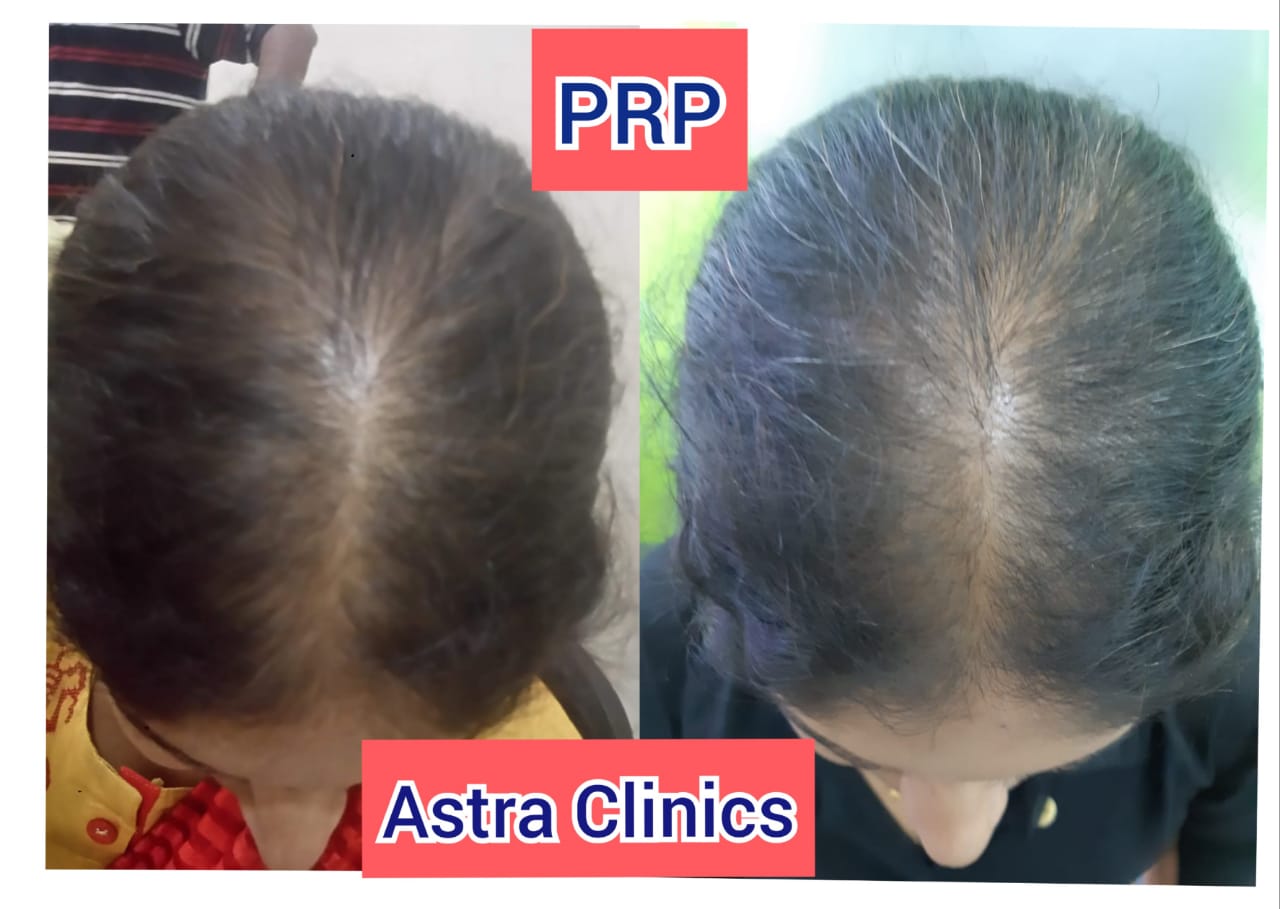 PRP Hair Transplant In Pune | Hair Transplant In Pune